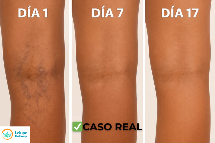 Parches Naturales para Varices y Piernas Cansadas