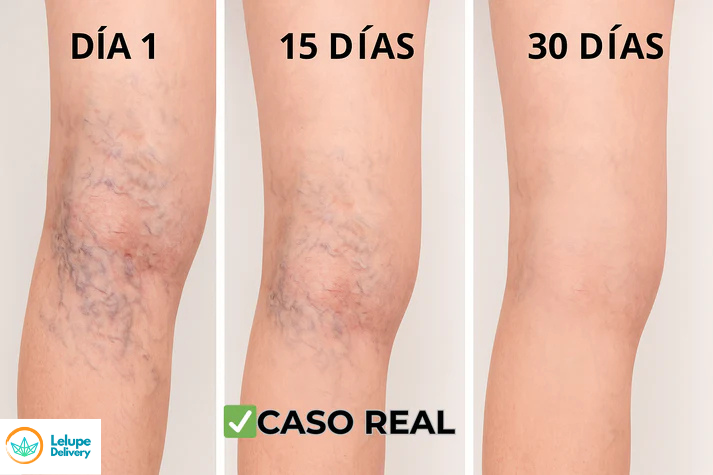 Parches Naturales para Varices y Piernas Cansadas